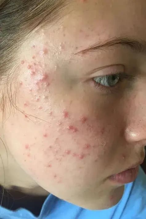 Acne Vulgaris