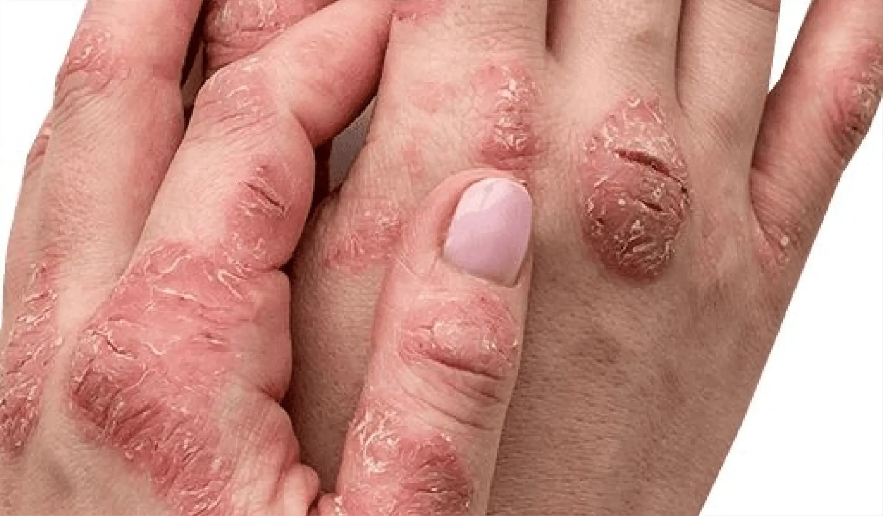 Eczema and Atopic Dermatitis