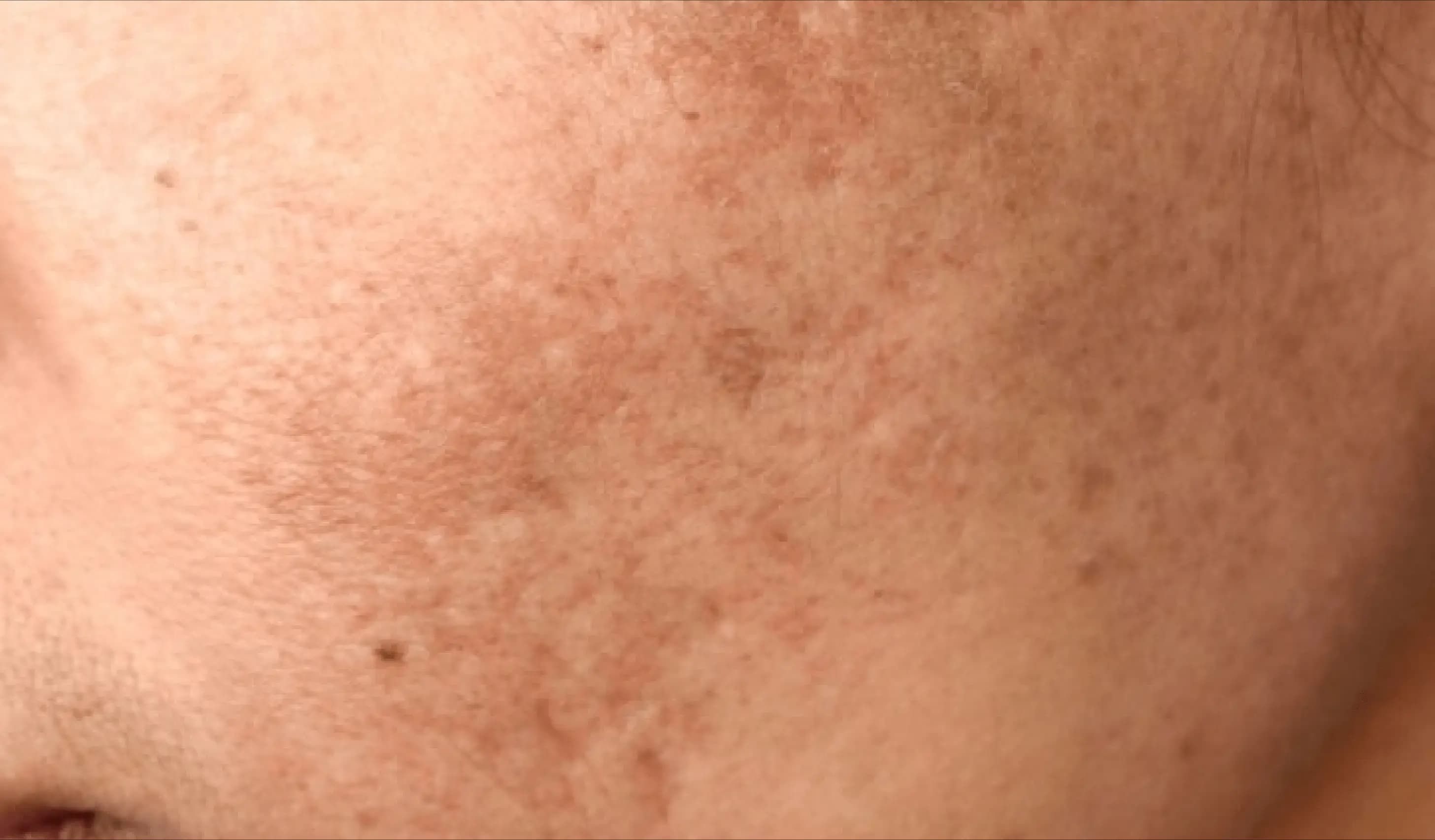Hyperpigmentation