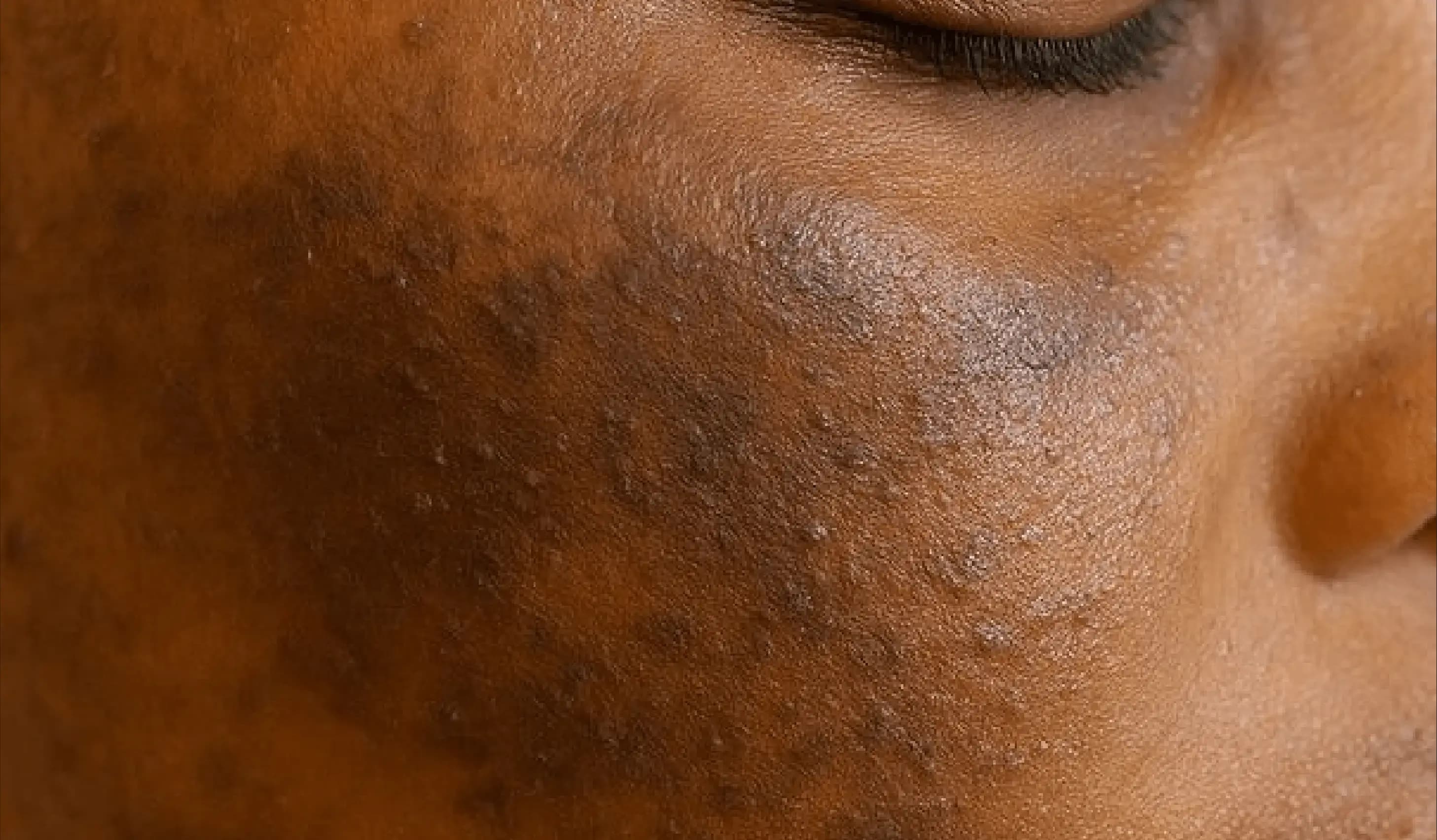 Melasma