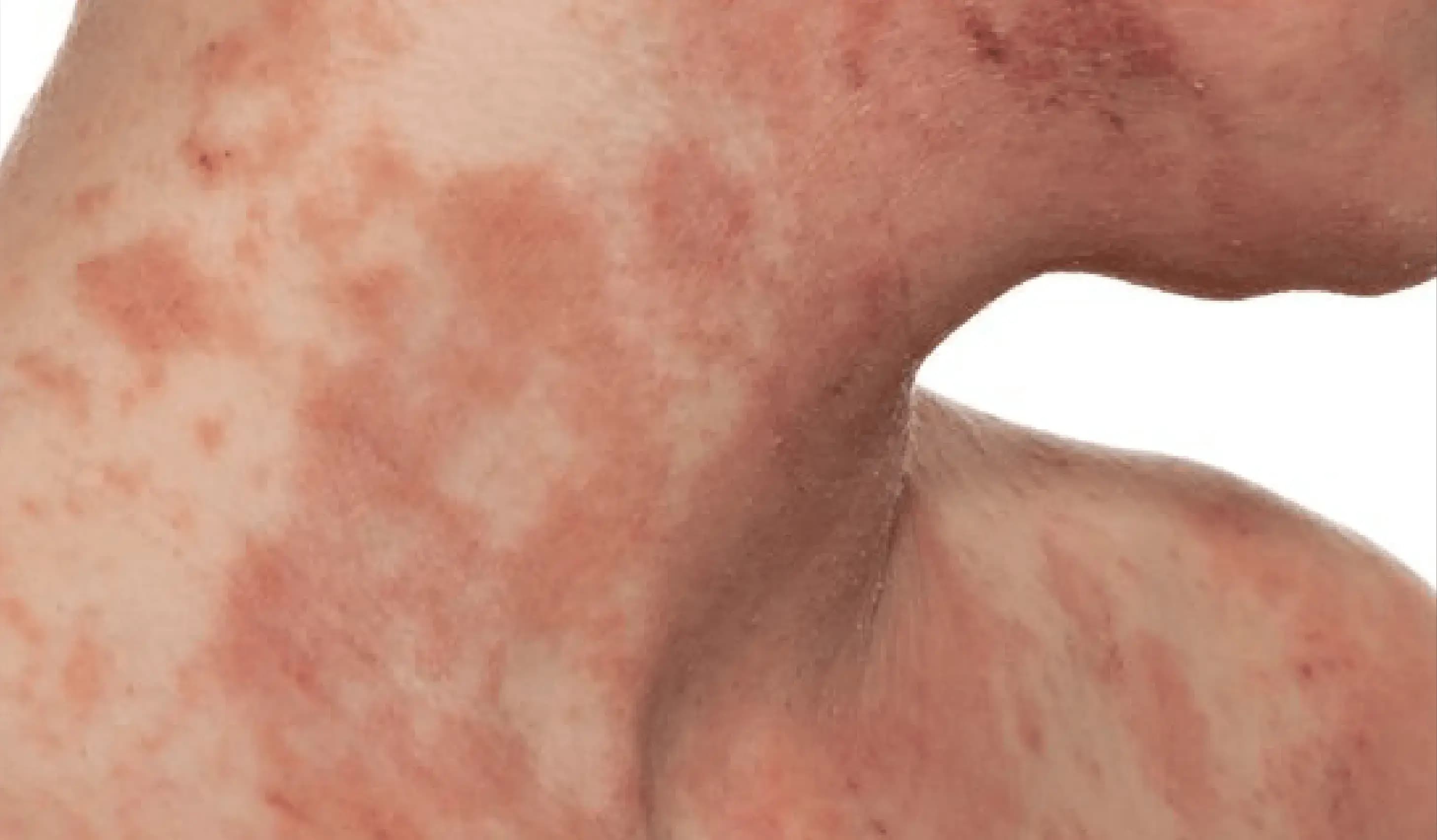 Psoriasis