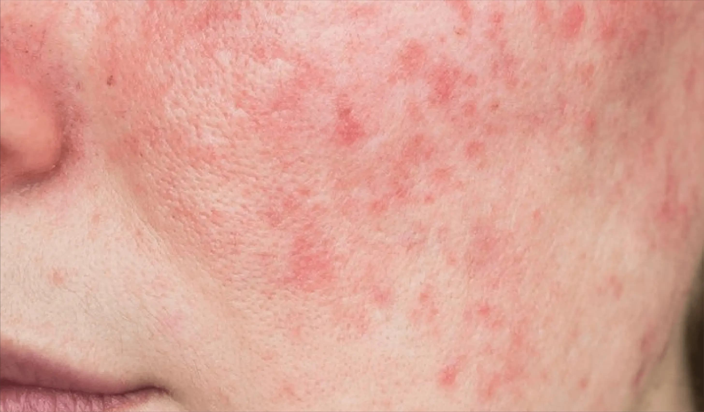 Rosacea