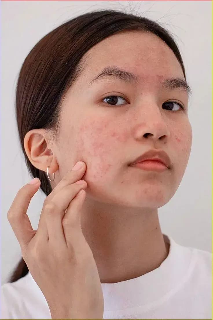 Stress and Skin