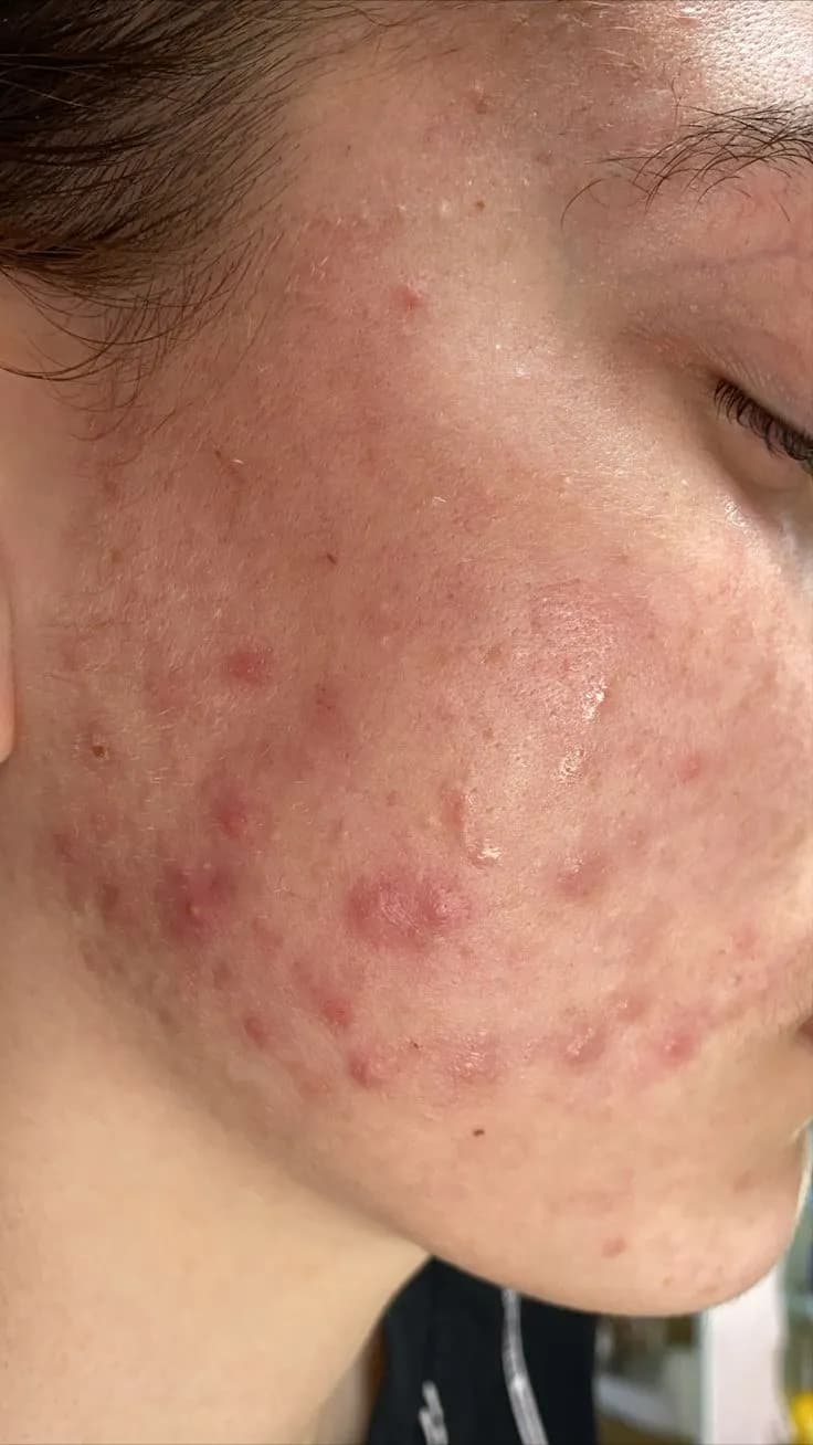 Autoimmune Response and Skin