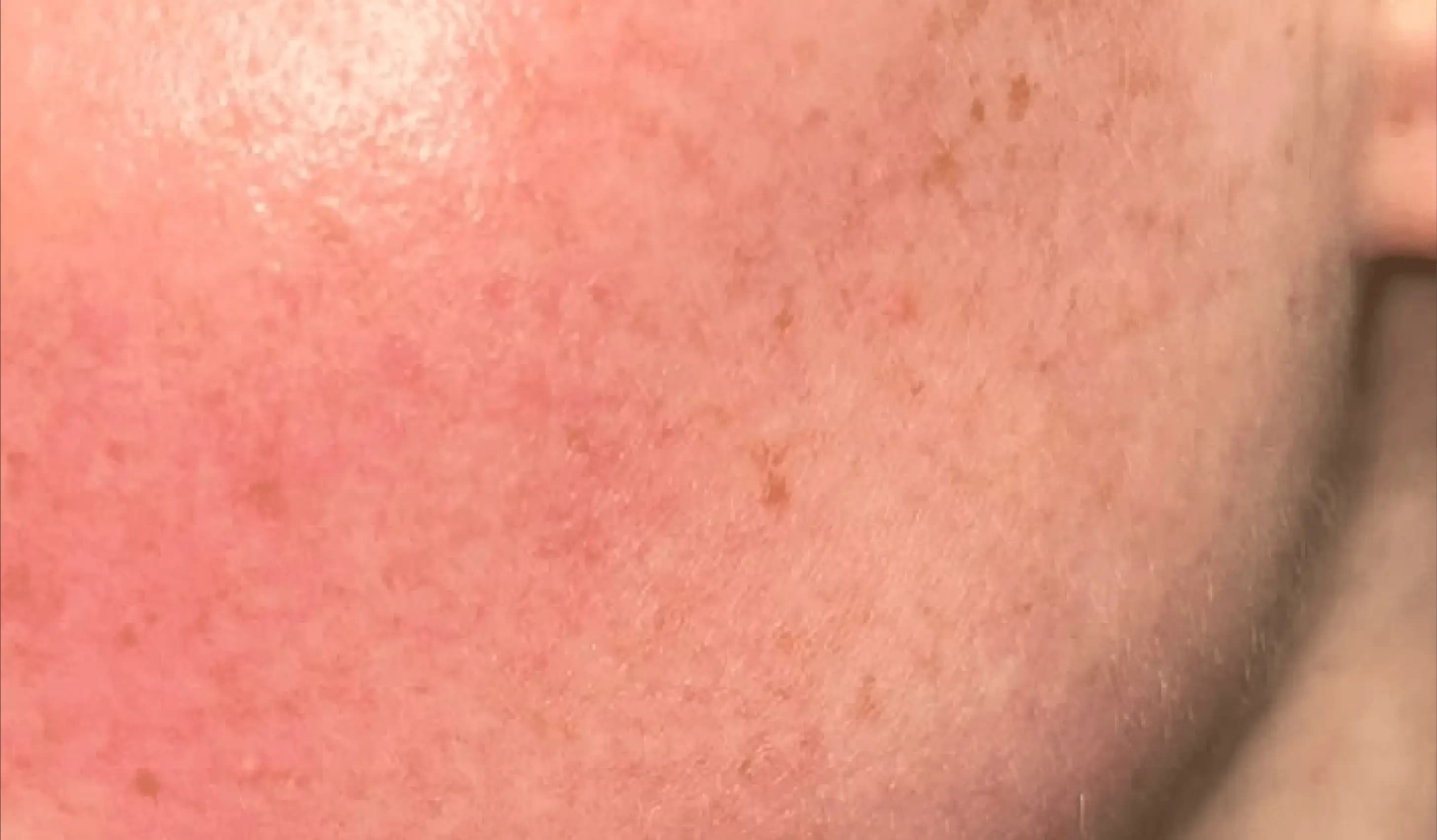 Skin Sensitivity