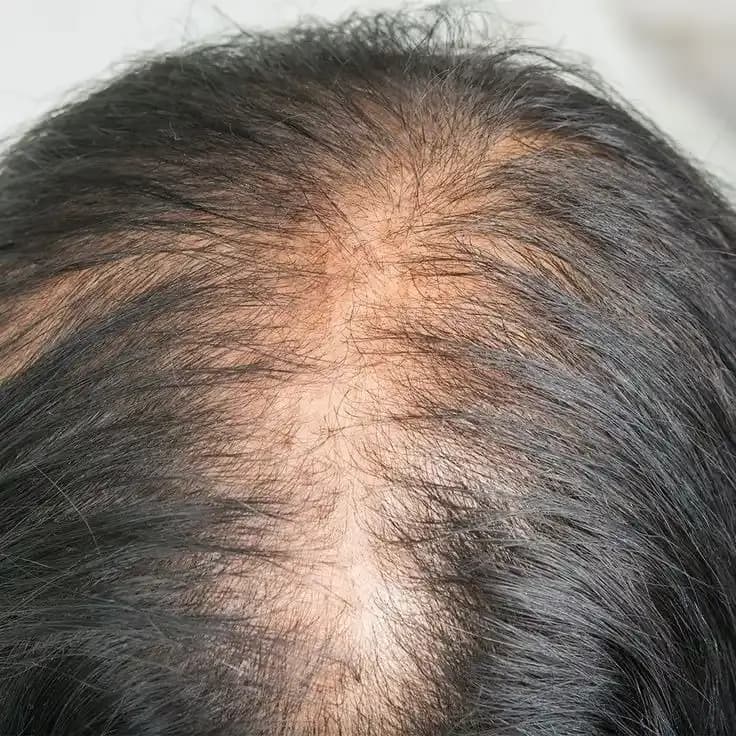 Telogen Effluvium